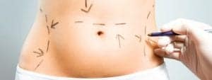 Liposuction – or No Indeed? Liposuction – or No Indeed?