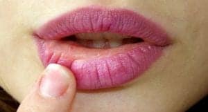 Dry Lip Causes & Dry Lip Treatments Dry Lip Causes & Dry Lip Treatments