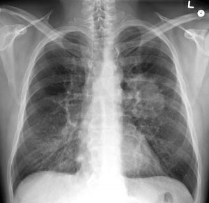 In a Revolutionary Medical Treatment, Man’s Lung Was Removed, Cleaned, and Replaced—No Transplant Necessary In a Revolutionary Medical Treatment, Man’s Lung Was Removed, Cleaned, and Replaced—No Transplant Necessary